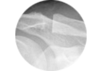 Auf diesem Bild sieht man eine Klavikularesektion in der Röntgenansicht