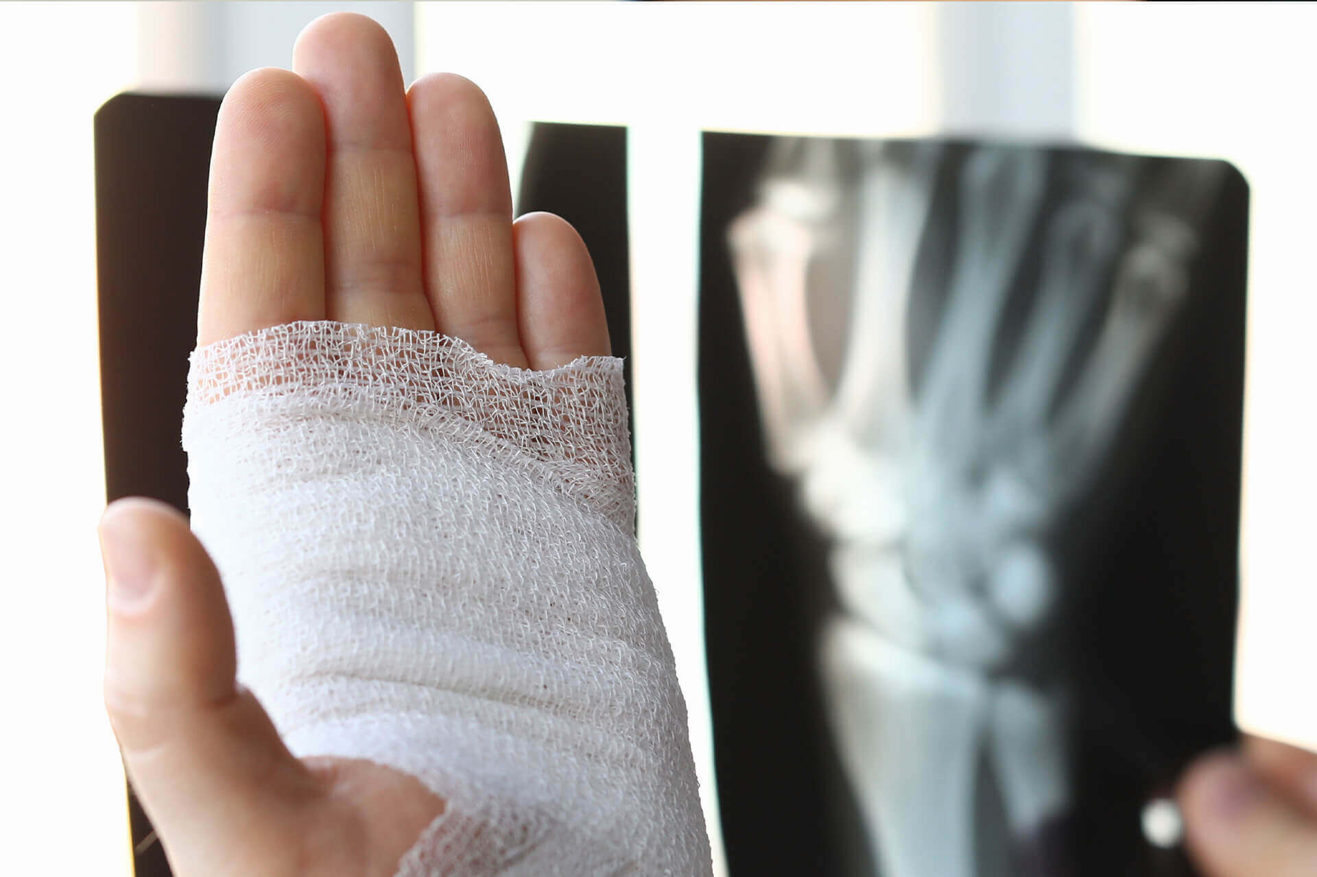Auf diesem Bild sieht man eine verbundene Hand. Auf der rechten Seite sieht man ein Röntgenbild der rechten Hand. Der Hintergrund ist hierbei verschwommen.