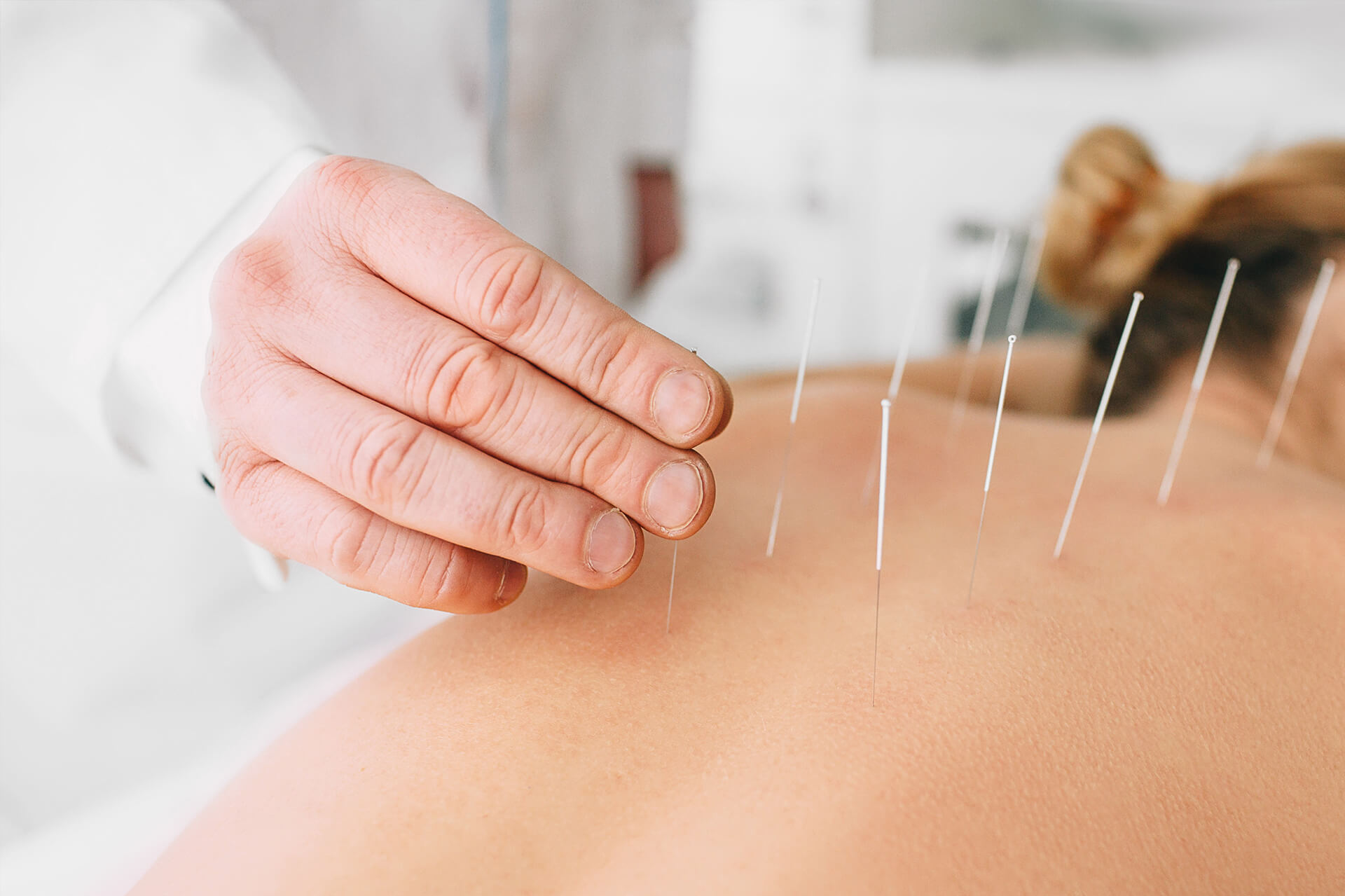 Hier sieht man mehrere Akupunkturnadeln, wie der Doktor gerade in einem Rücken einer jungen Dame rein steckt